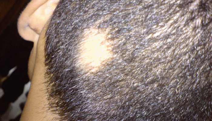 alopecia1